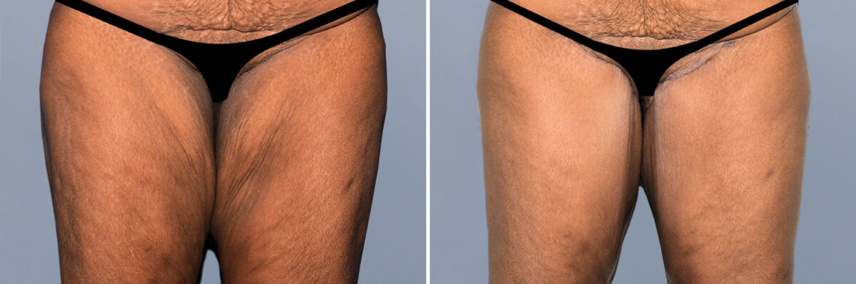 Body Procedures before and after photos in FL, Palm Beach Gardens, Patient 1211