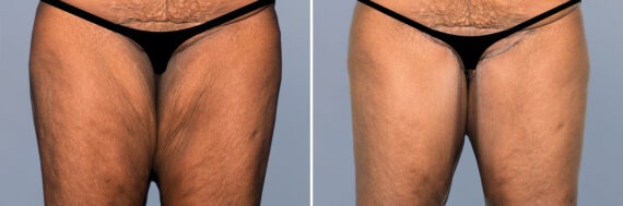 Body Procedures before and after photos in FL, Palm Beach Gardens, Patient 1211