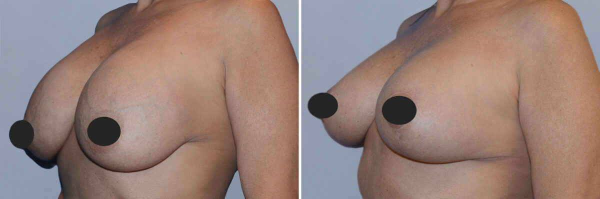 Breast Augmentation and Lift before and after photos in FL, Palm Beach Gardens, Patient 1216