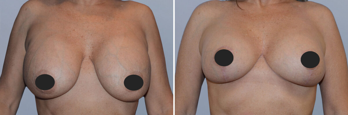 Breast Augmentation and Lift before and after photos in FL, Palm Beach Gardens, Patient 1216