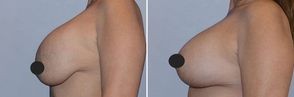 Breast Augmentation and Lift before and after photos in FL, Palm Beach Gardens, Patient 1216