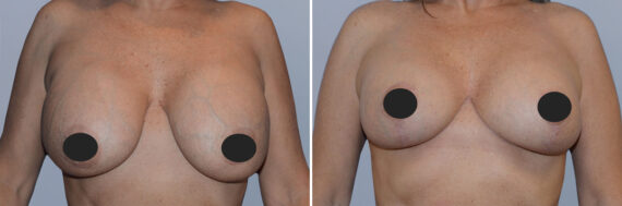 Breast Augmentation and Lift before and after photos in FL, Palm Beach Gardens, Patient 1216