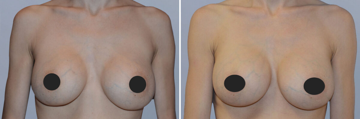 Breast Augmentation before and after photos in FL, Palm Beach Gardens, Patient 1223