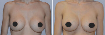 Breast Augmentation before and after photos in FL, Palm Beach Gardens, Patient 1223