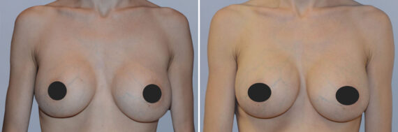 Breast Augmentation before and after photos in FL, Palm Beach Gardens, Patient 1223