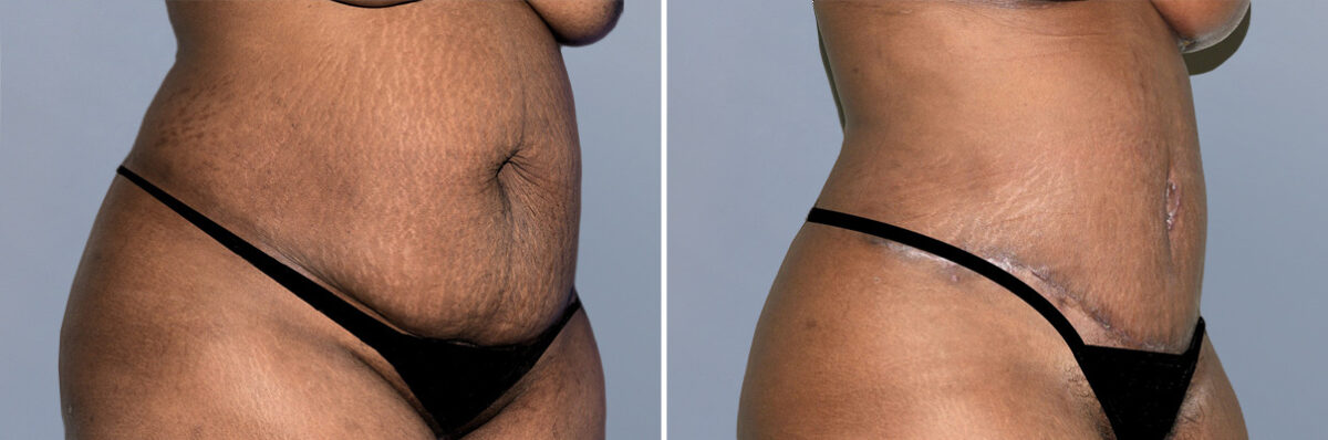 Body Procedures before and after photos in FL, Palm Beach Gardens, Patient 1226