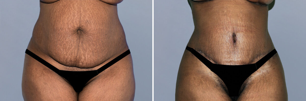 Body Procedures before and after photos in FL, Palm Beach Gardens, Patient 1226