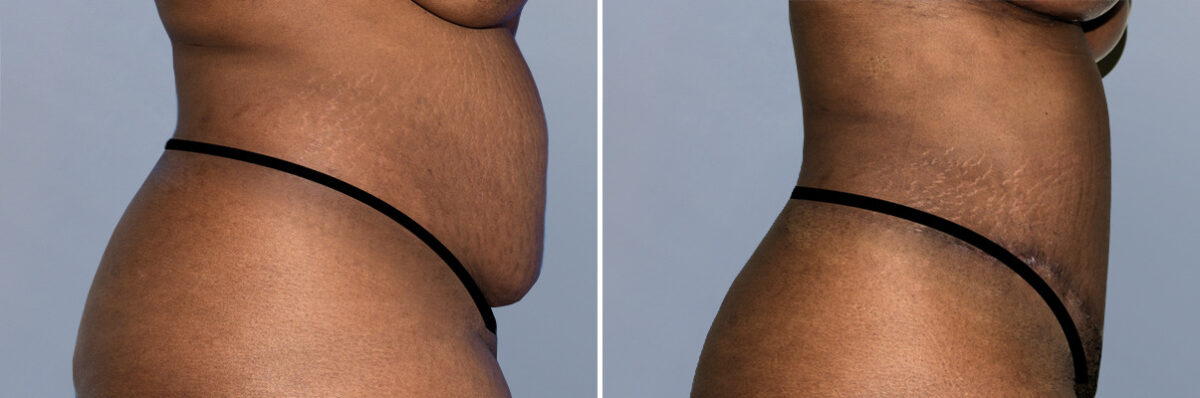 Body Procedures before and after photos in FL, Palm Beach Gardens, Patient 1226