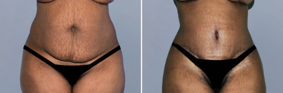 Body Procedures before and after photos in FL, Palm Beach Gardens, Patient 1226