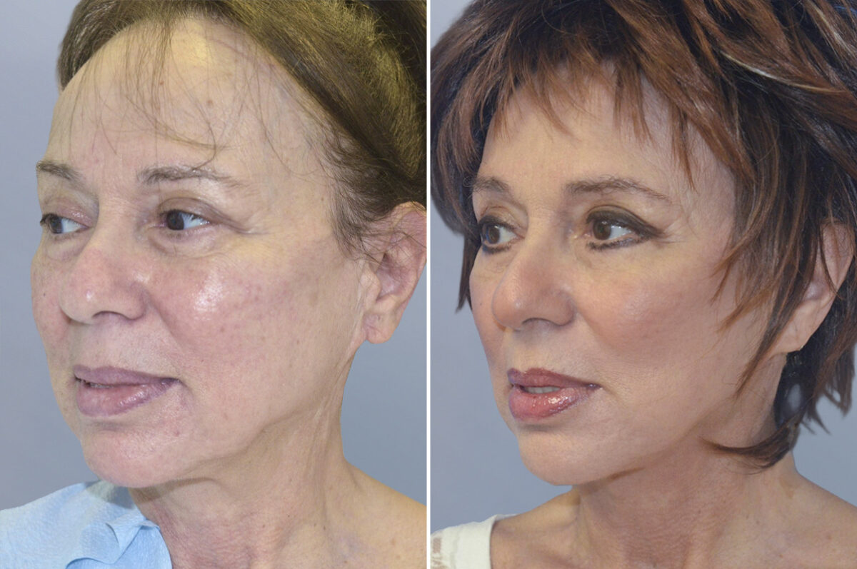 Face Procedures before and after photos in FL, Palm Beach Gardens, Patient 1233