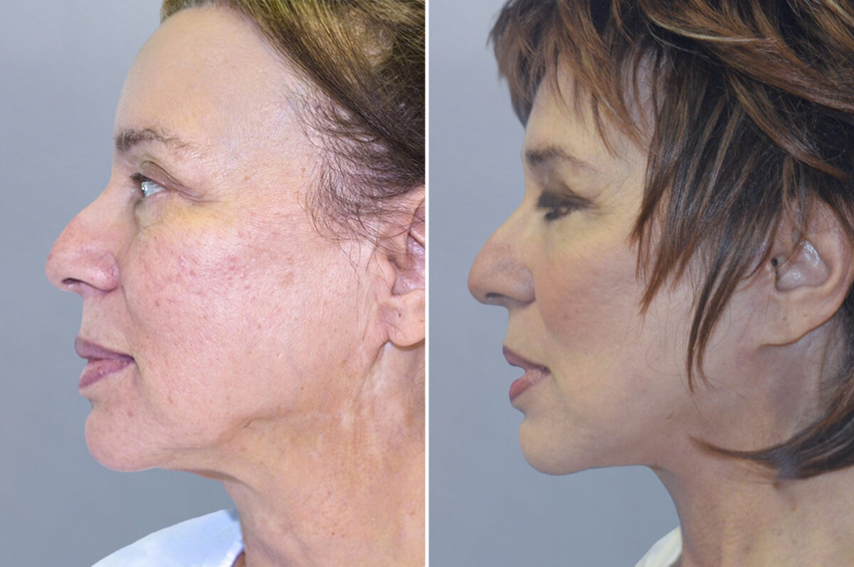 Face Procedures before and after photos in FL, Palm Beach Gardens, Patient 1233