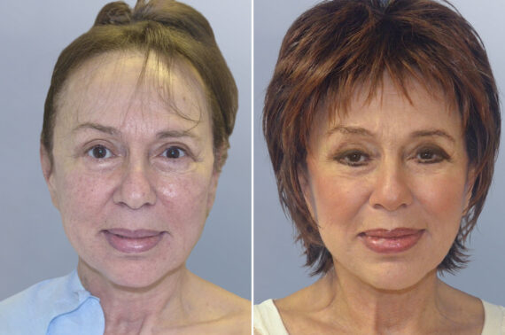 Face Procedures before and after photos in FL, Palm Beach Gardens, Patient 1233