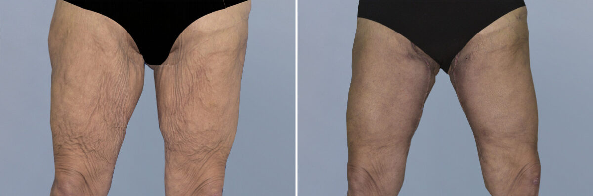 Body Procedures before and after photos in FL, Palm Beach Gardens, Patient 1240