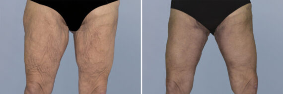 Body Procedures before and after photos in FL, Palm Beach Gardens, Patient 1240