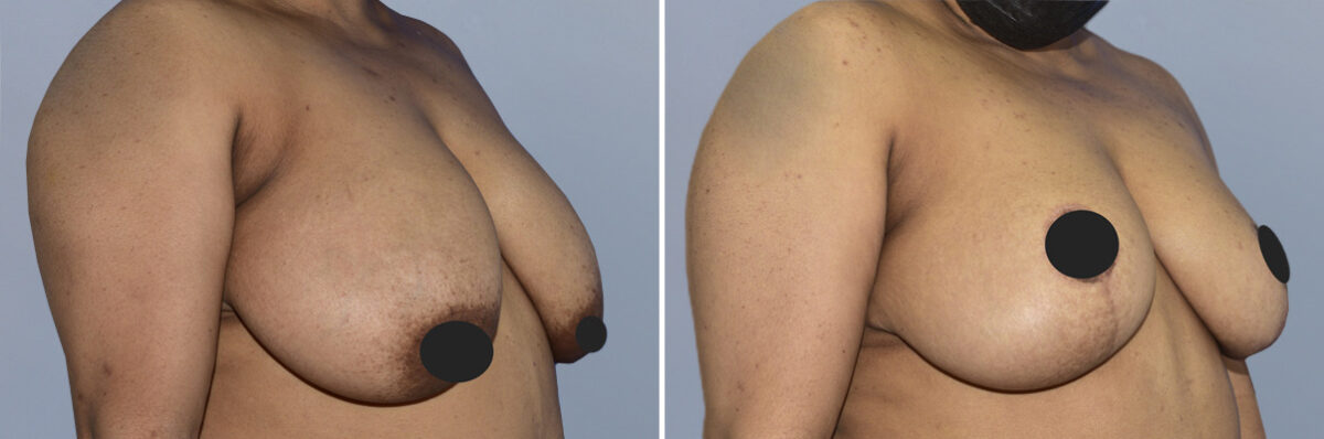 Breast Lift (Mastopexy) before and after photos in FL, Palm Beach Gardens, Patient 1243