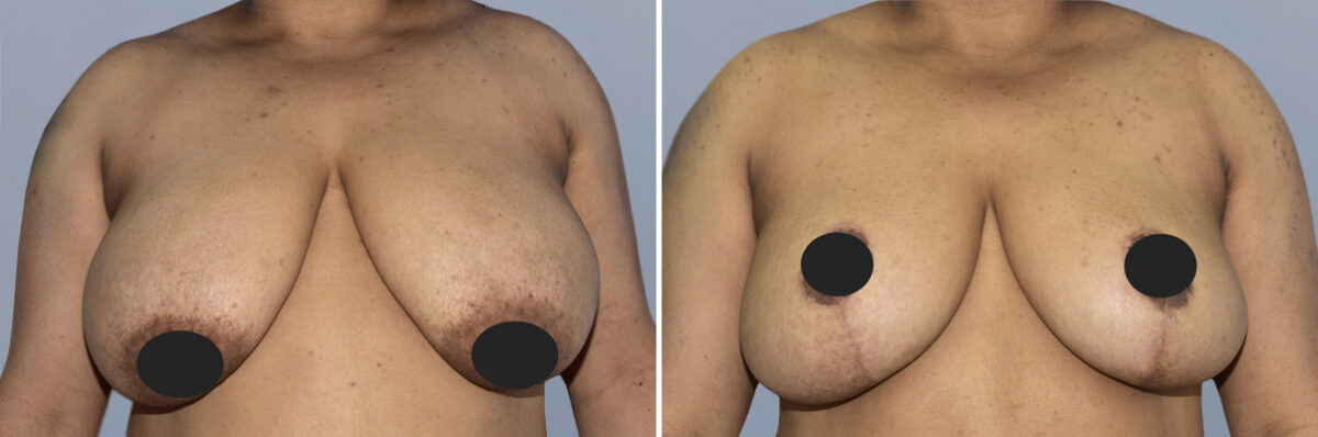Breast Lift (Mastopexy) before and after photos in FL, Palm Beach Gardens, Patient 1243