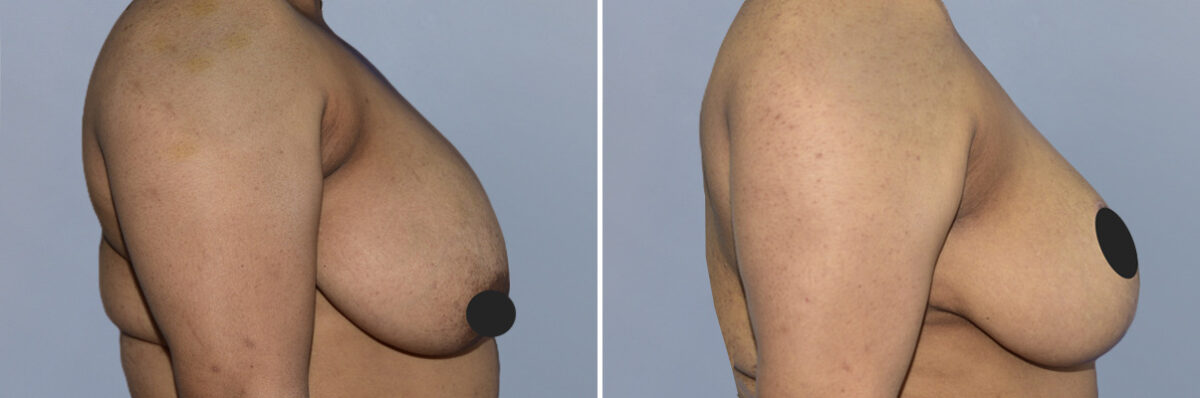 Breast Lift (Mastopexy) before and after photos in FL, Palm Beach Gardens, Patient 1243