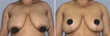 Breast Lift (Mastopexy) before and after photos in FL, Palm Beach Gardens, Patient 1243