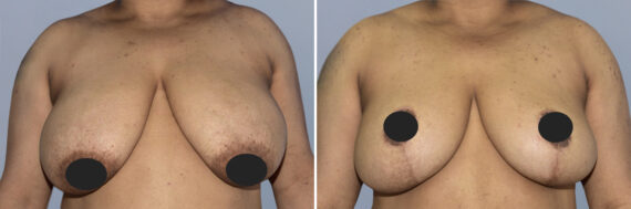 Breast Lift (Mastopexy) before and after photos in FL, Palm Beach Gardens, Patient 1243