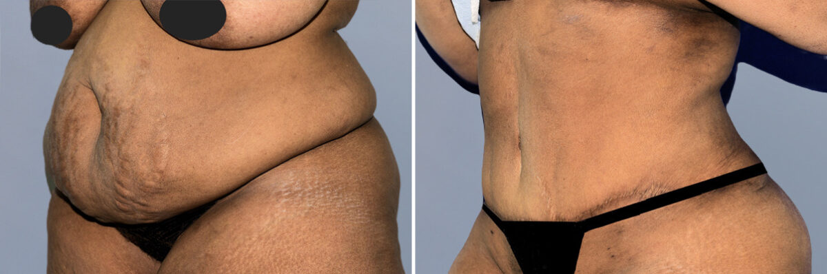 Body Procedures before and after photos in FL, Palm Beach Gardens, Patient 1250