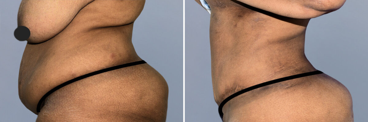 Body Procedures before and after photos in FL, Palm Beach Gardens, Patient 1250