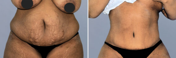 Body Procedures before and after photos in FL, Palm Beach Gardens, Patient 1250