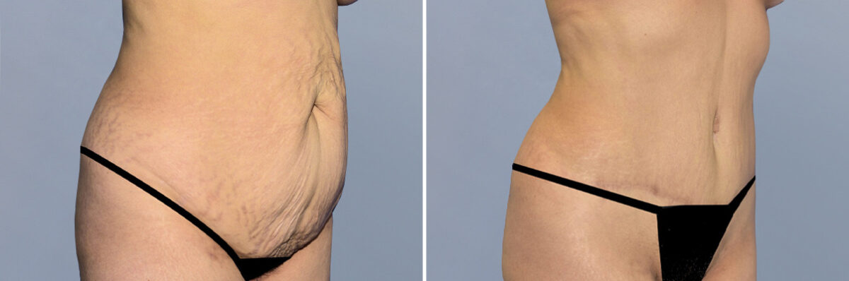 Body Procedures before and after photos in FL, Palm Beach Gardens, Patient 1257