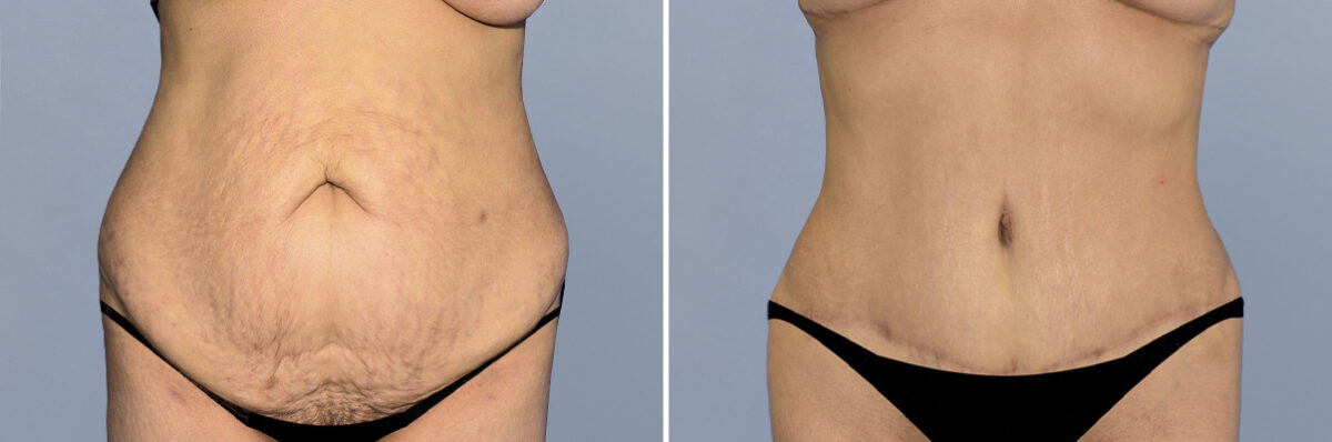 Body Procedures before and after photos in FL, Palm Beach Gardens, Patient 1257