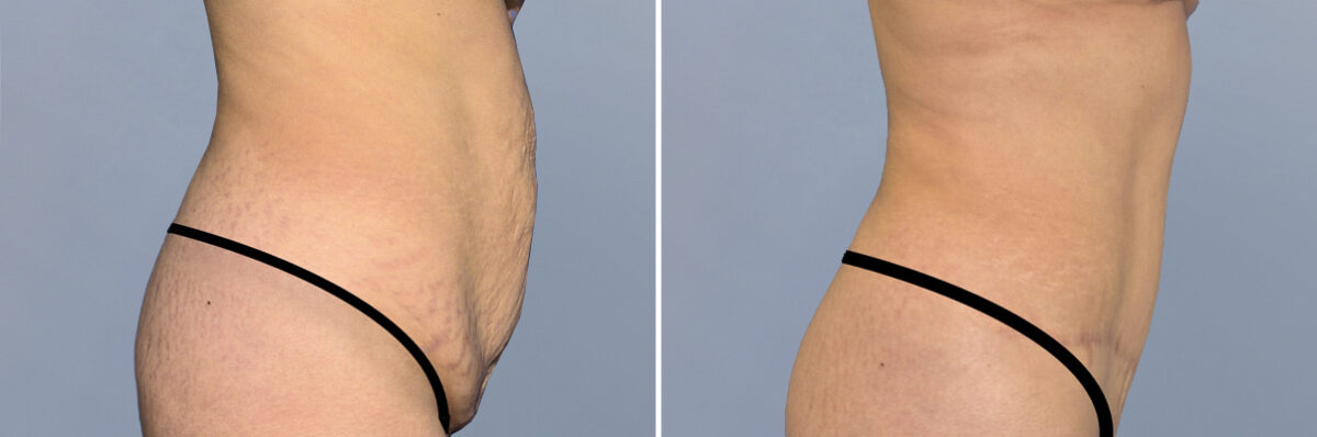 Body Procedures before and after photos in FL, Palm Beach Gardens, Patient 1257