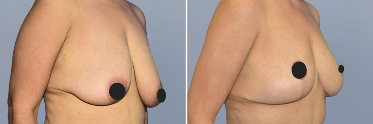 Breast Lift (Mastopexy) before and after photos in FL, Palm Beach Gardens, Patient 1264