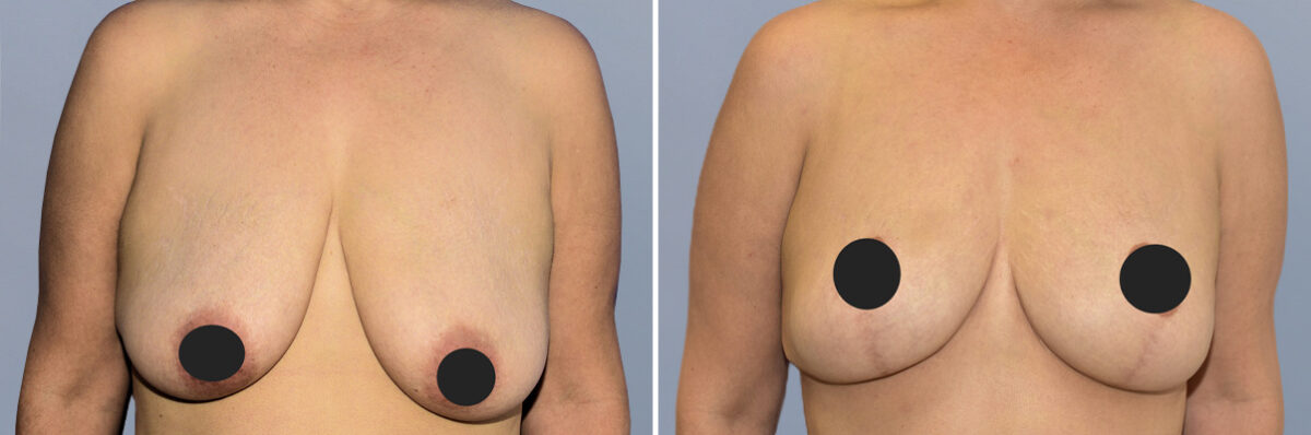Breast Lift (Mastopexy) before and after photos in FL, Palm Beach Gardens, Patient 1264