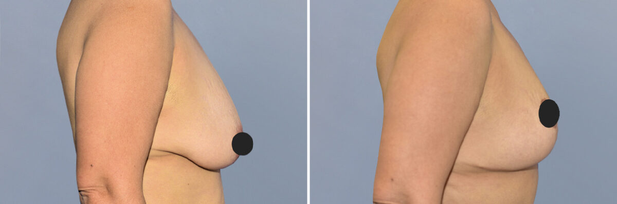 Breast Lift (Mastopexy) before and after photos in FL, Palm Beach Gardens, Patient 1264