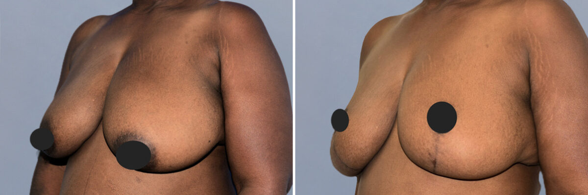 Breast Lift (Mastopexy) before and after photos in FL, Palm Beach Gardens, Patient 1271