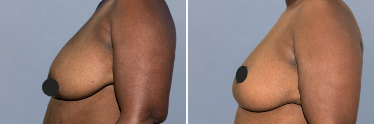 Breast Lift (Mastopexy) before and after photos in FL, Palm Beach Gardens, Patient 1271