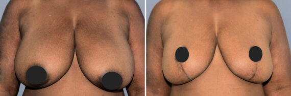 Breast Lift (Mastopexy) before and after photos in FL, Palm Beach Gardens, Patient 1271
