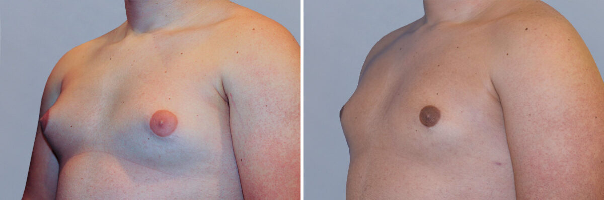 Breast Procedures before and after photos in FL, Palm Beach Gardens, Patient 1278
