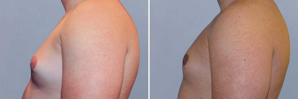 Breast Procedures before and after photos in FL, Palm Beach Gardens, Patient 1278