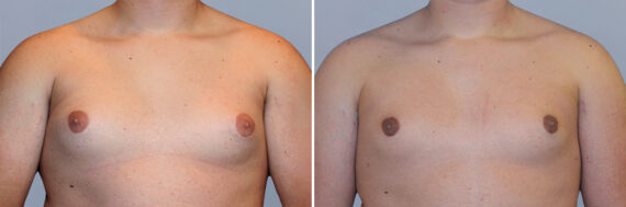 Breast Procedures before and after photos in FL, Palm Beach Gardens, Patient 1278