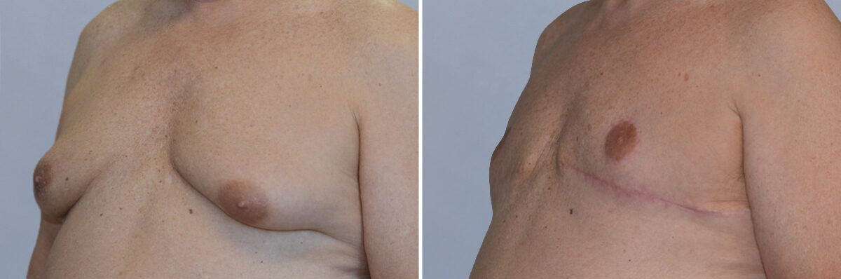 Breast Procedures before and after photos in FL, Palm Beach Gardens, Patient 1285