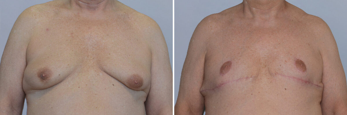 Breast Procedures before and after photos in FL, Palm Beach Gardens, Patient 1285