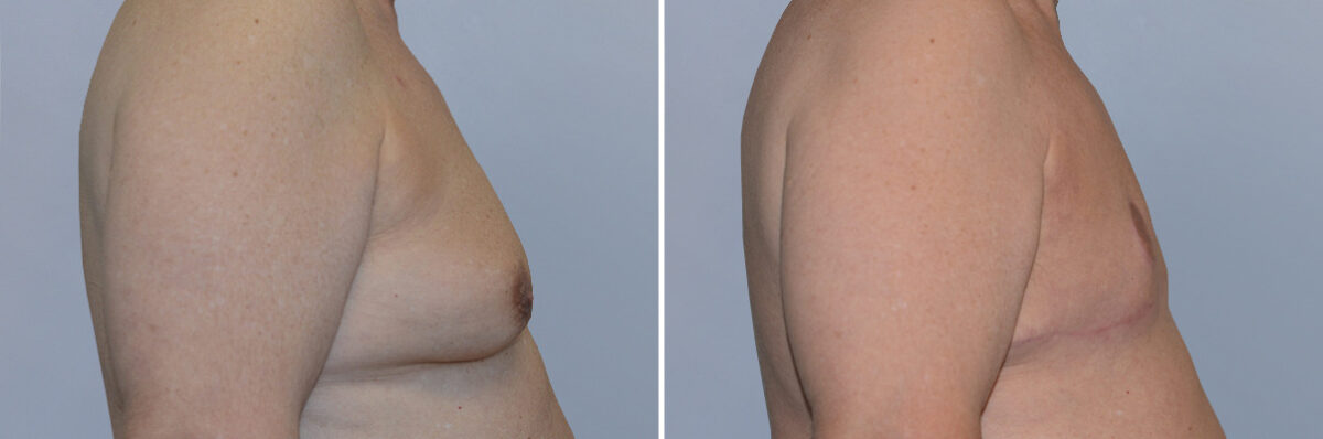 Breast Procedures before and after photos in FL, Palm Beach Gardens, Patient 1285