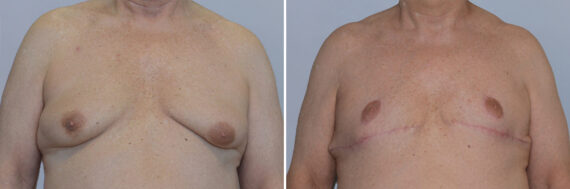 Male Breast Reduction (Gynecomastia) before and after photos in FL, Palm Beach Gardens