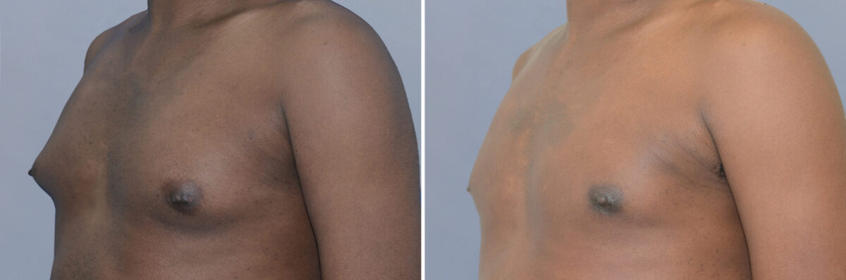 Breast Procedures before and after photos in FL, Palm Beach Gardens, Patient 1292