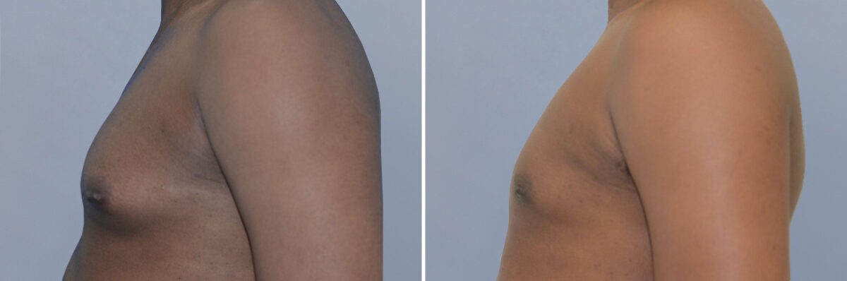 Breast Procedures before and after photos in FL, Palm Beach Gardens, Patient 1292