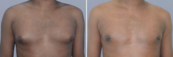 Breast Procedures before and after photos in FL, Palm Beach Gardens, Patient 1292