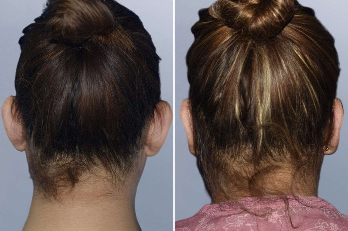 Face Procedures before and after photos in FL, Palm Beach Gardens, Patient 1299