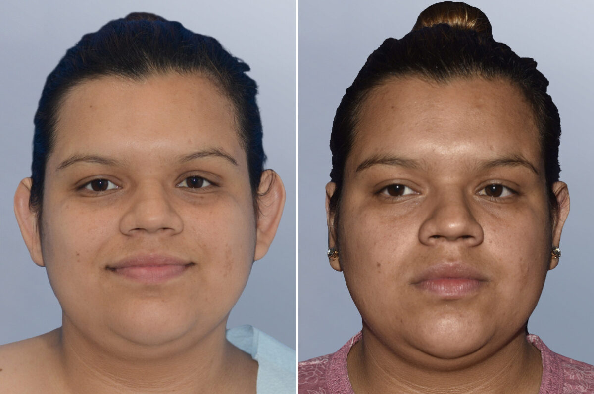 Face Procedures before and after photos in FL, Palm Beach Gardens, Patient 1299