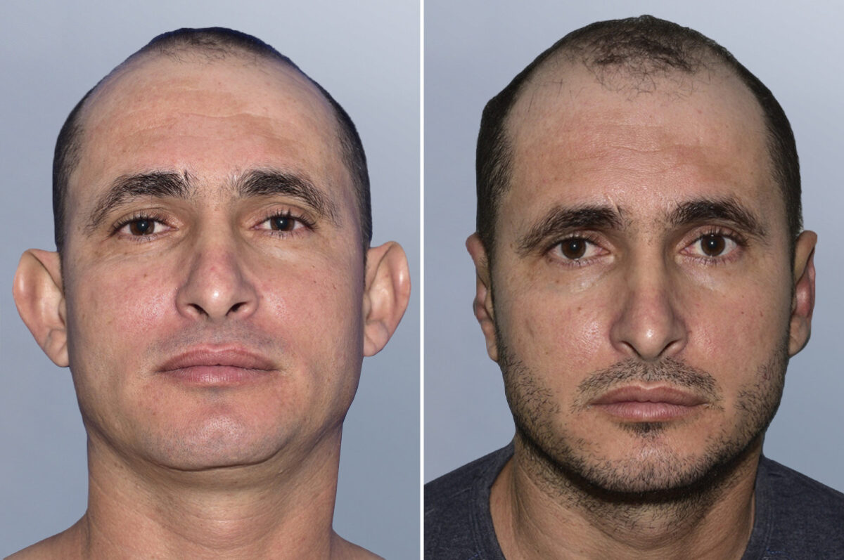 Face Procedures before and after photos in FL, Palm Beach Gardens, Patient 1299