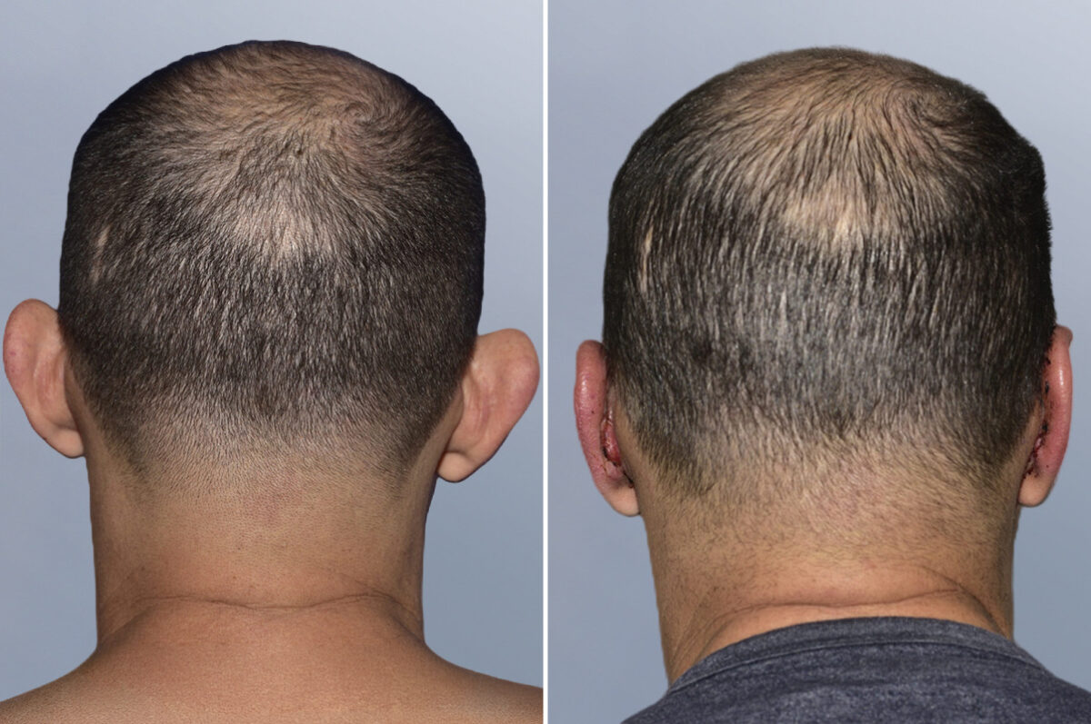 Face Procedures before and after photos in FL, Palm Beach Gardens, Patient 1299