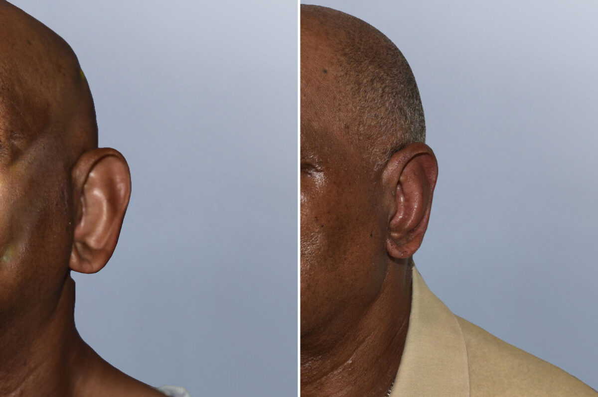 Face Procedures before and after photos in FL, Palm Beach Gardens, Patient 1299